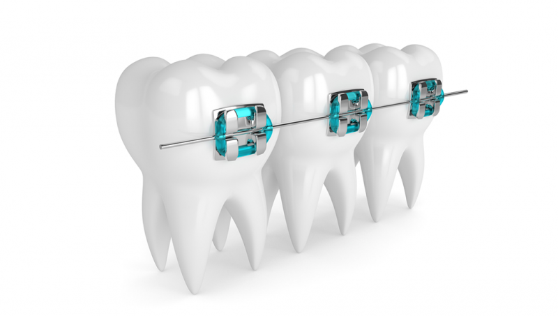 Презентация брекеты ортодонтия