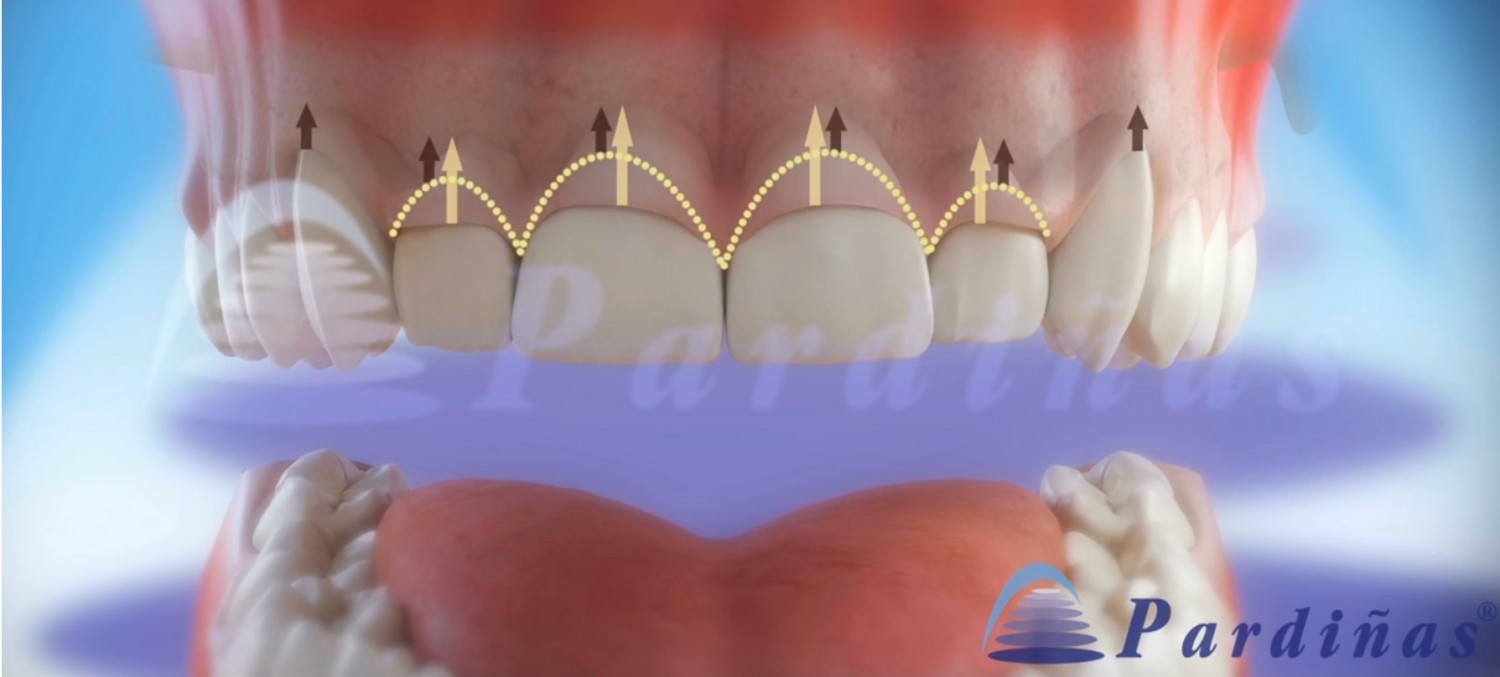 Удлинение зубов при помощи лазера