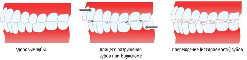 Скрип зубами или бруксизм